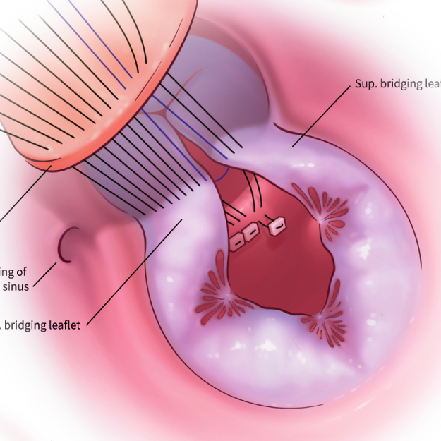 An illustration of a heart surgery