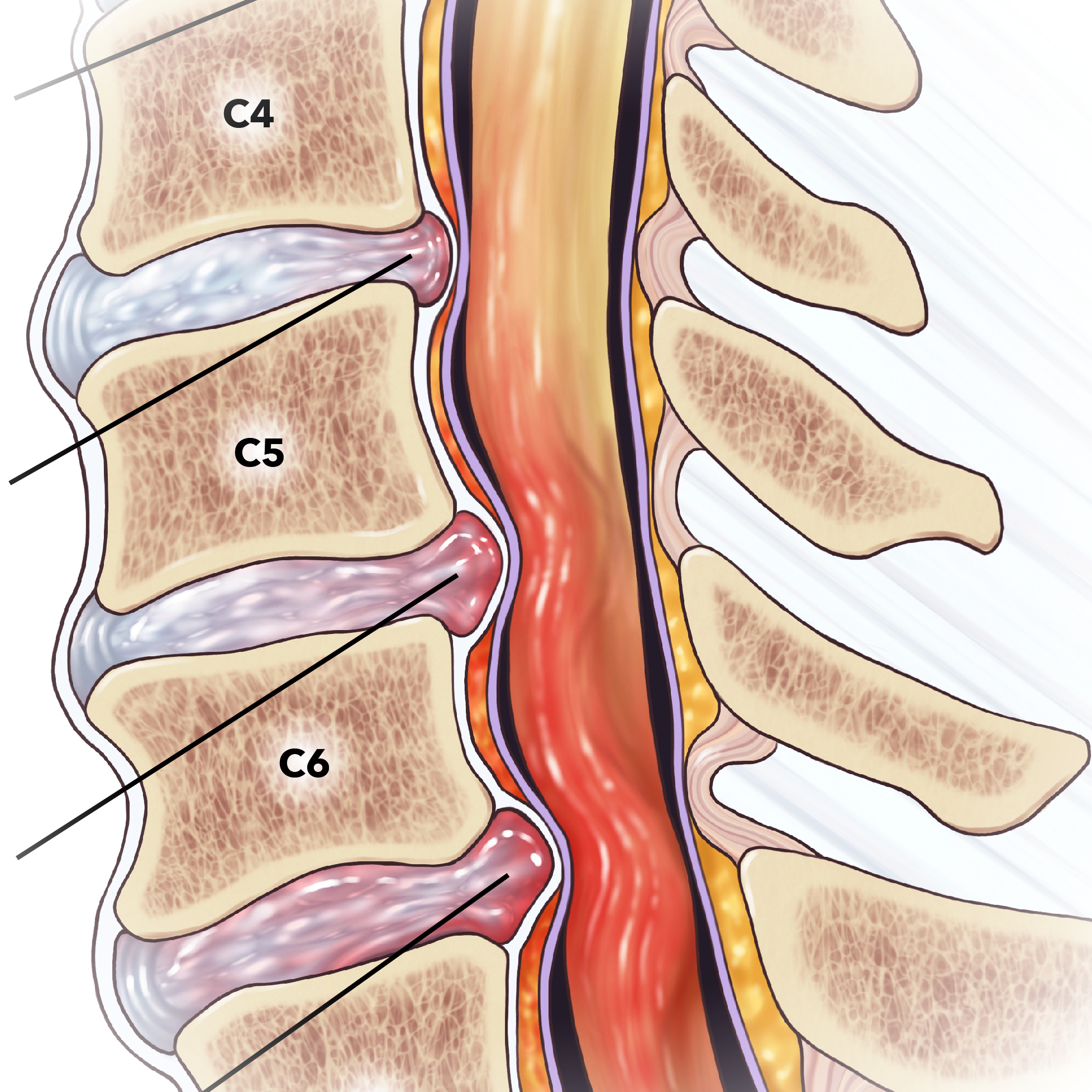 An illustration of a cervical fracture